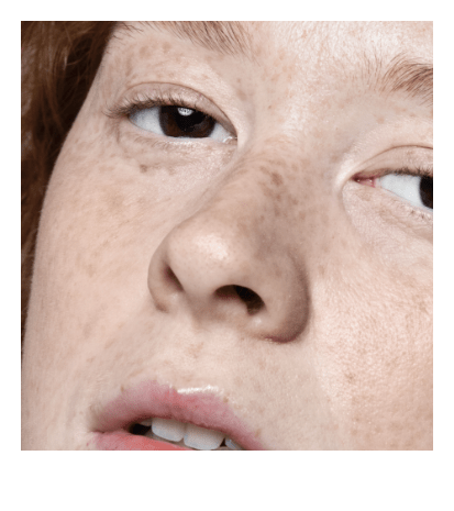 HYPERPIGMENTATION