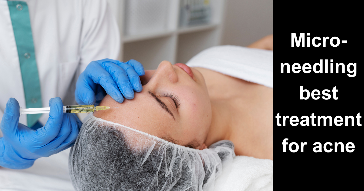 How Micro-Needling Can Reduce Acne Scars