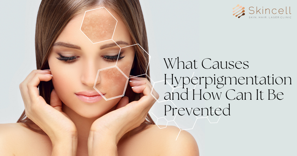 What Causes Hyperpigmentation and How Can It Be Prevented