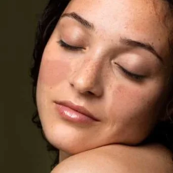MELASMA 1 MELASMA 1