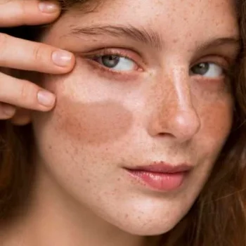 MELASMA MELASMA