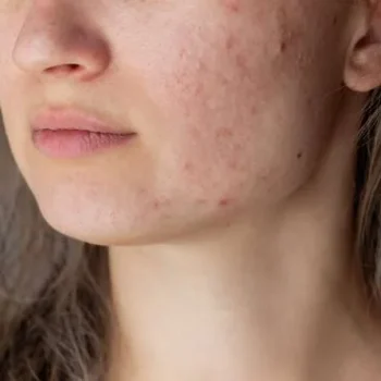 acne scares acne scares